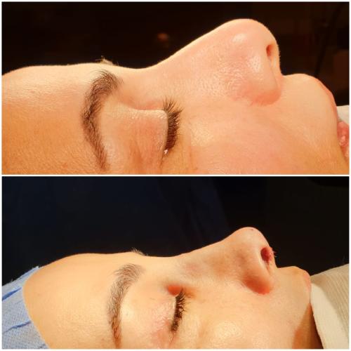 Rinoplastia ultrasónica Fotos del antes y el después
